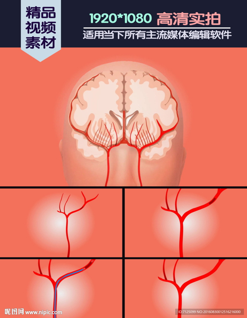 缺血性梗死醫(yī)學(xué)演示動(dòng)畫