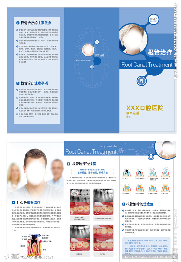 根管治療
