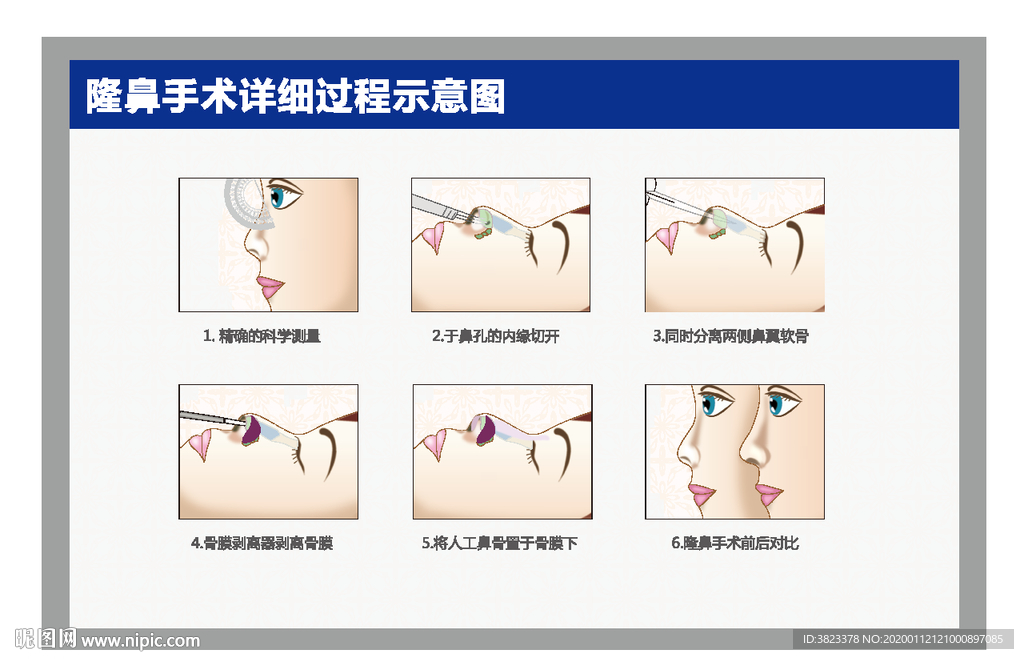 隆鼻手术过程