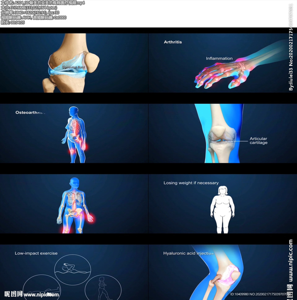 A204_3D骨關節炎關節疾病