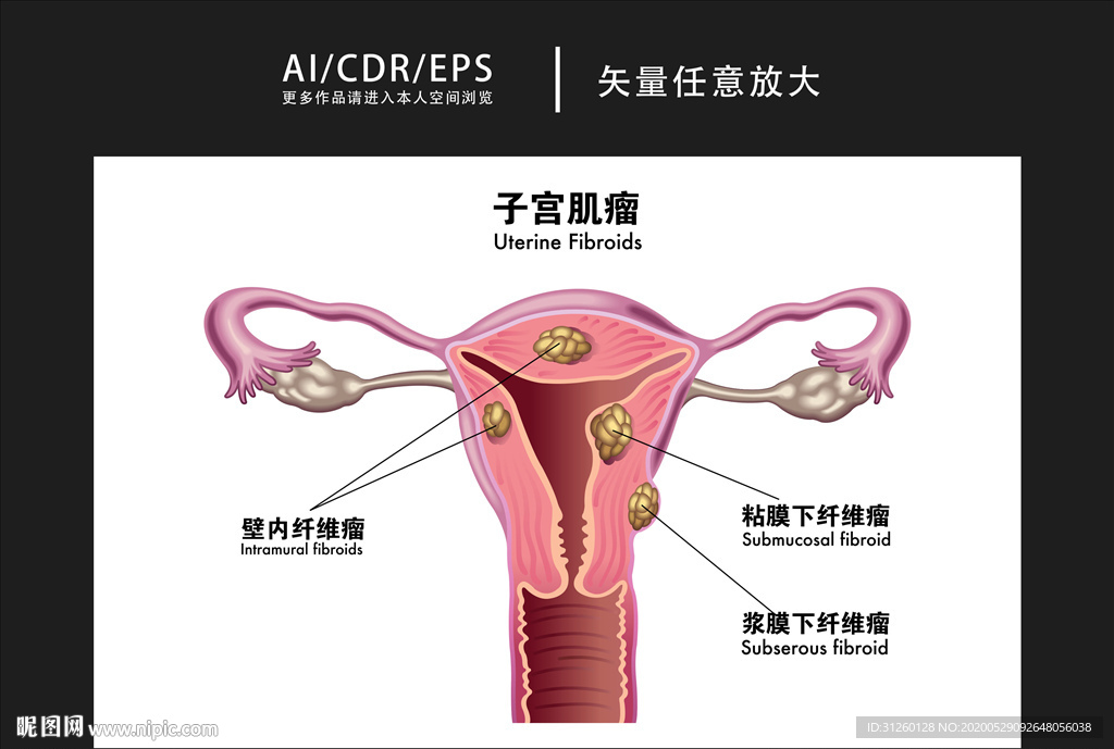 矢量醫(yī)學子宮肌瘤圖解插畫
