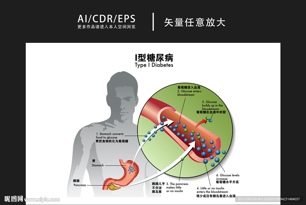 矢量醫(yī)學(xué)I型糖尿病圖解插畫