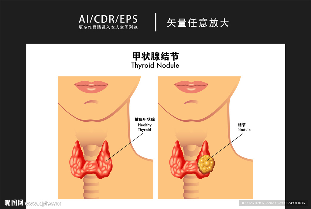 矢量醫(yī)學(xué)甲狀腺結(jié)節(jié)圖解插畫(huà)