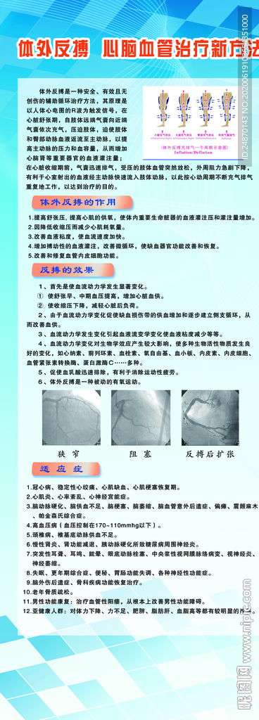 體外反搏 心腦血管治療新方法