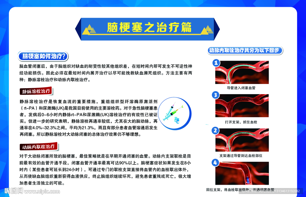 卒中血栓取栓展板