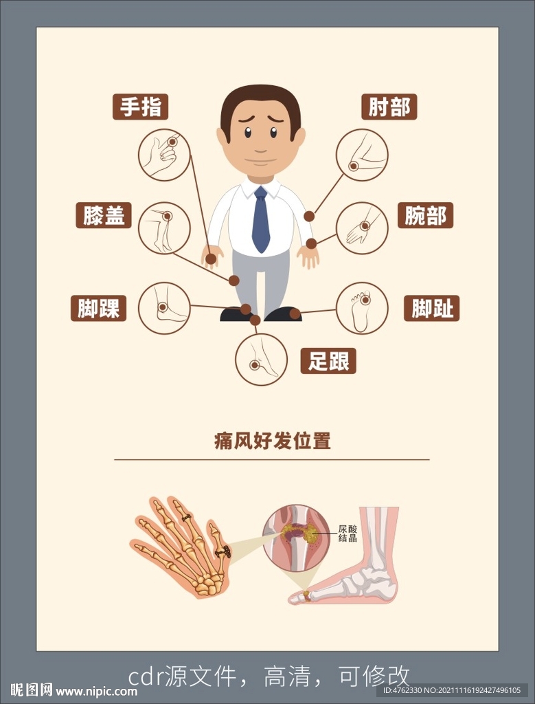 痛風(fēng)經(jīng)常發(fā)展部位圖