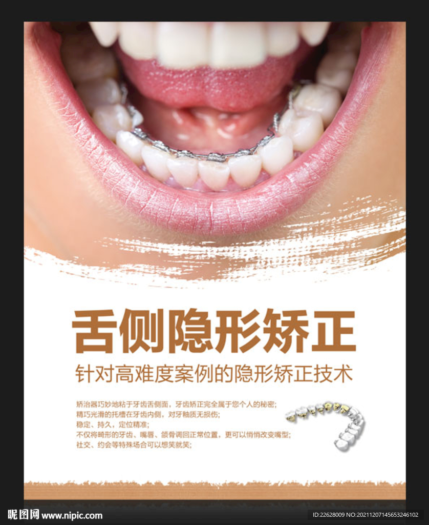 舌側牙齒矯正