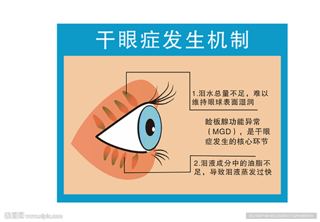 干眼癥發(fā)生機(jī)制