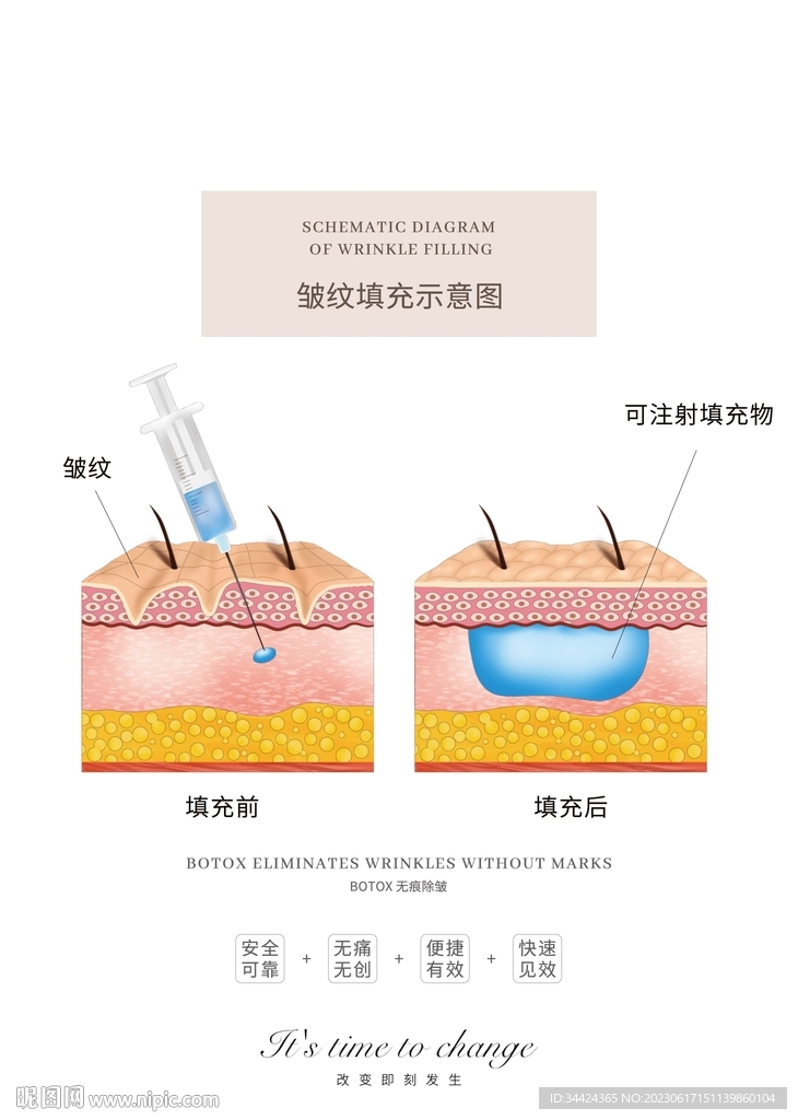 皱纹填充示意图