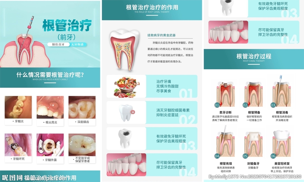 根管治療