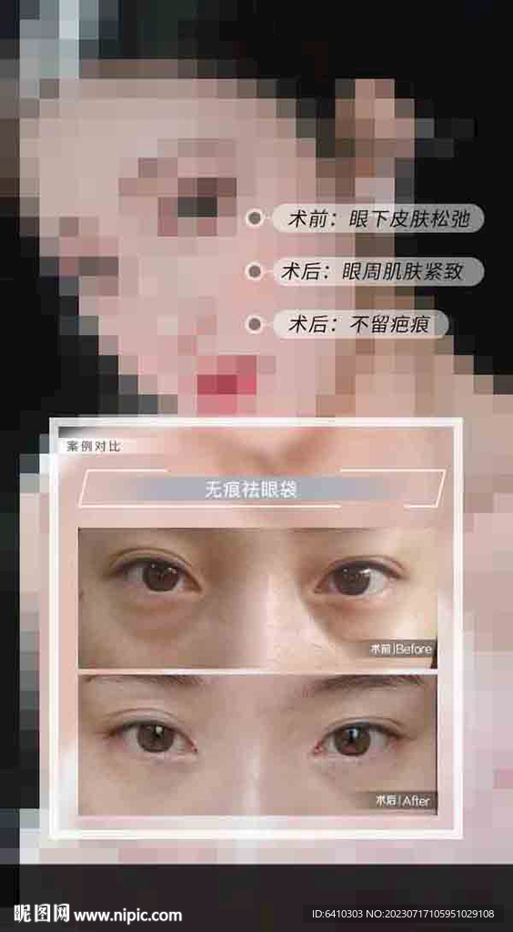 祛眼袋案例