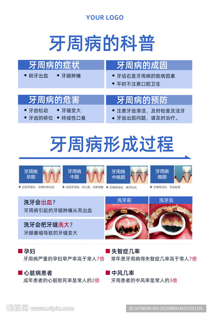 牙周病科普