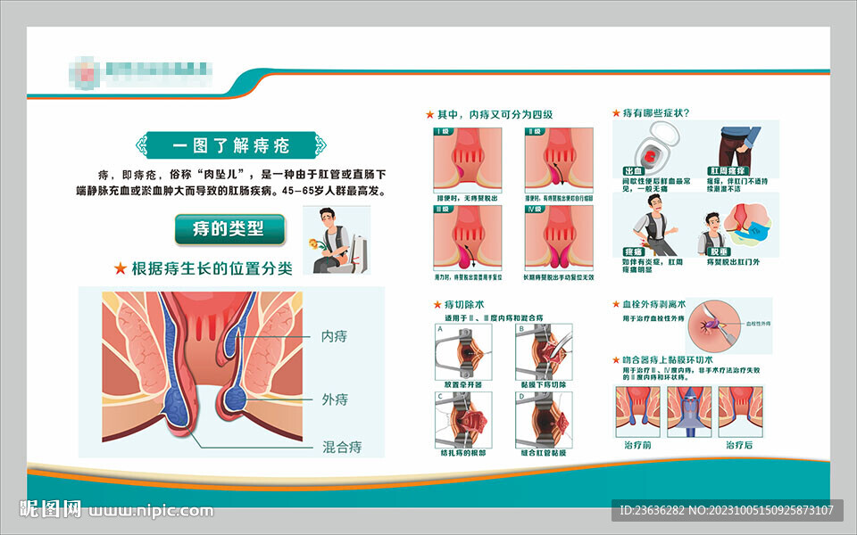 一圖了解痔瘡