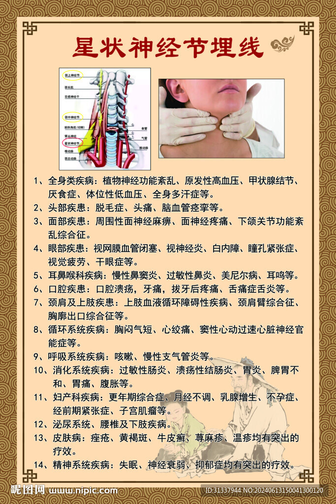 星狀神經(jīng)節(jié)埋線