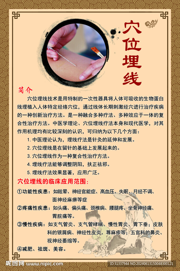 穴位埋線