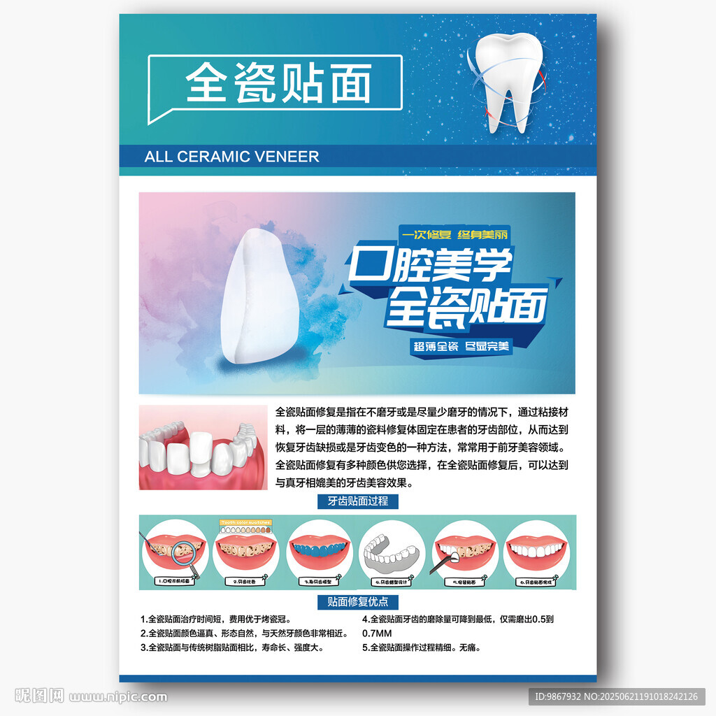 全瓷貼面