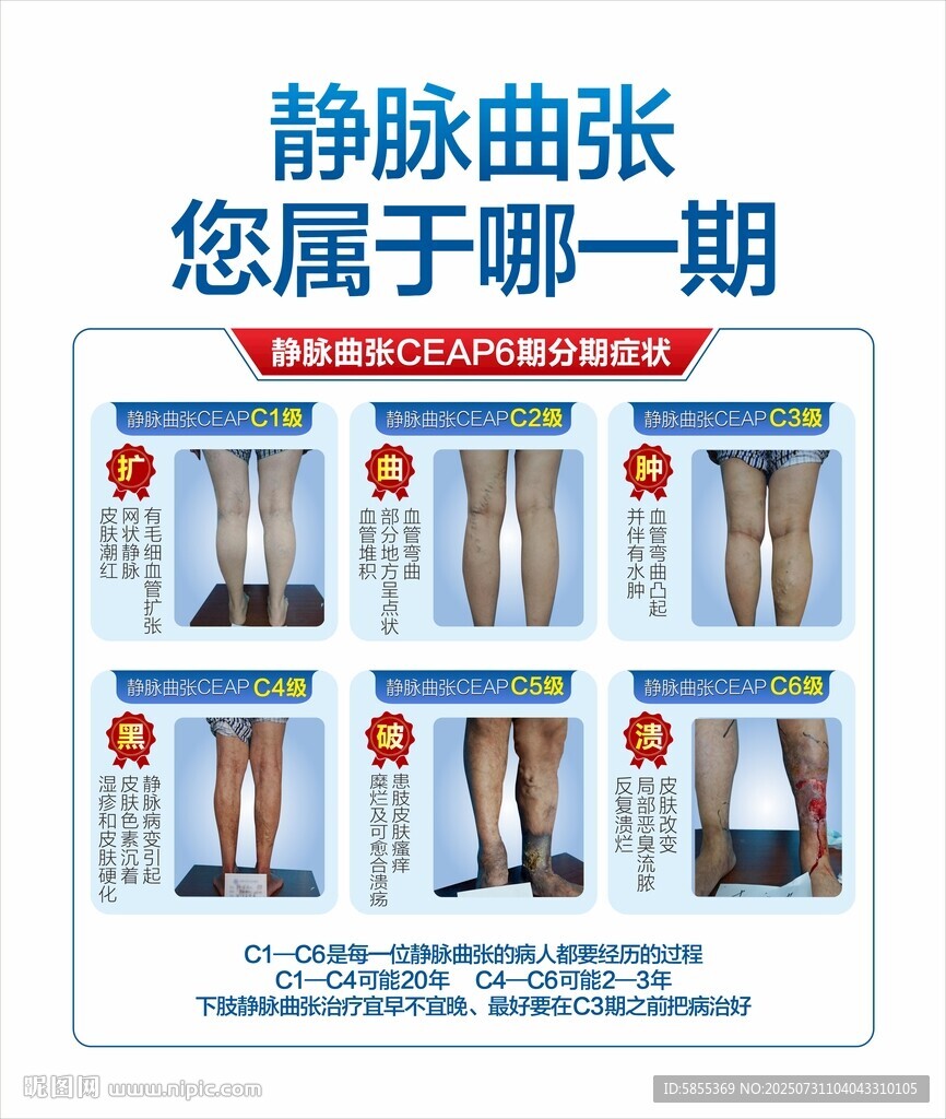 靜脈曲張分期圖