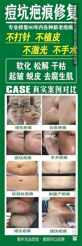 痘坑疤痕修復(fù)