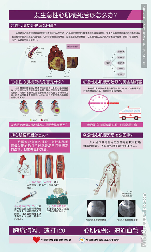 急性心肌梗死