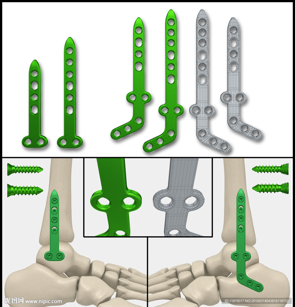 医疗器械 医疗钢板