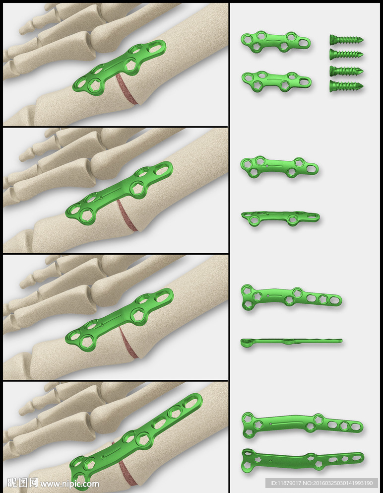 医疗器械 医疗钢板