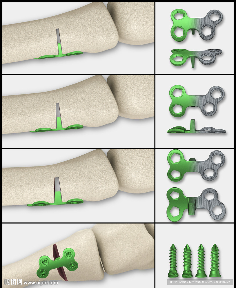 医疗器械 医疗钢板