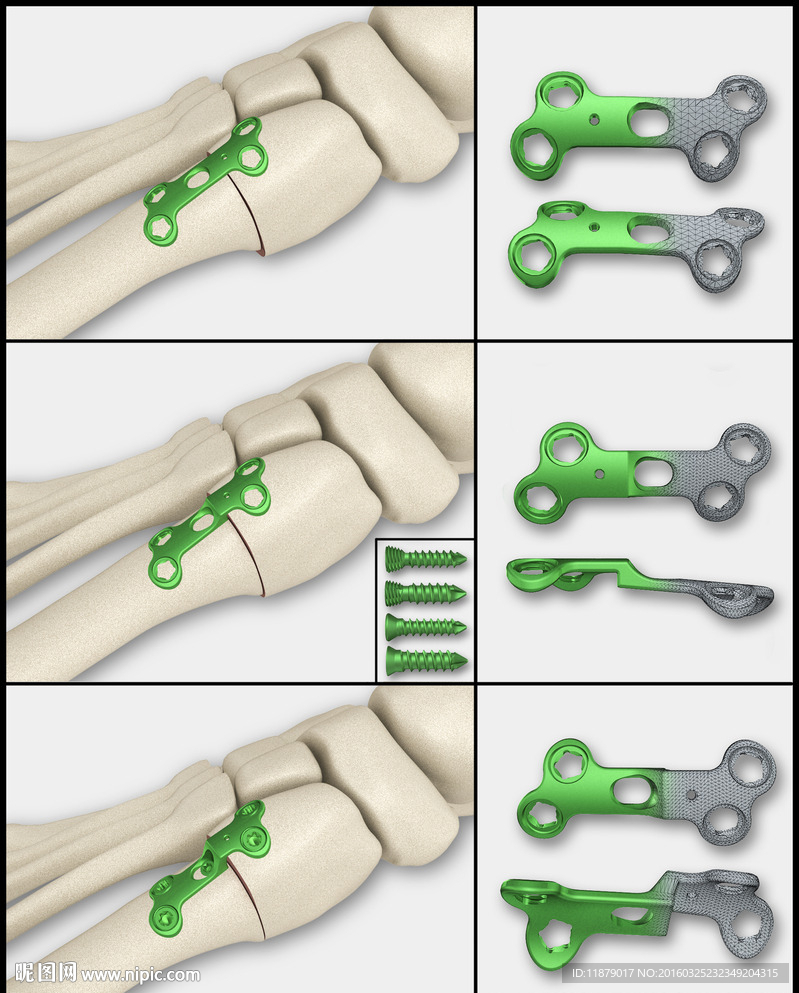 医疗器械 医疗钢板