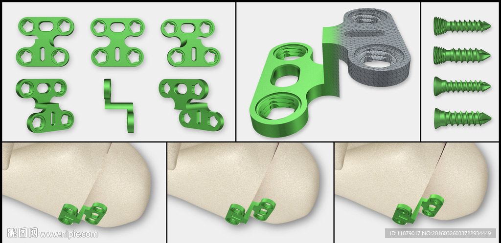 医疗器械 医疗钢板