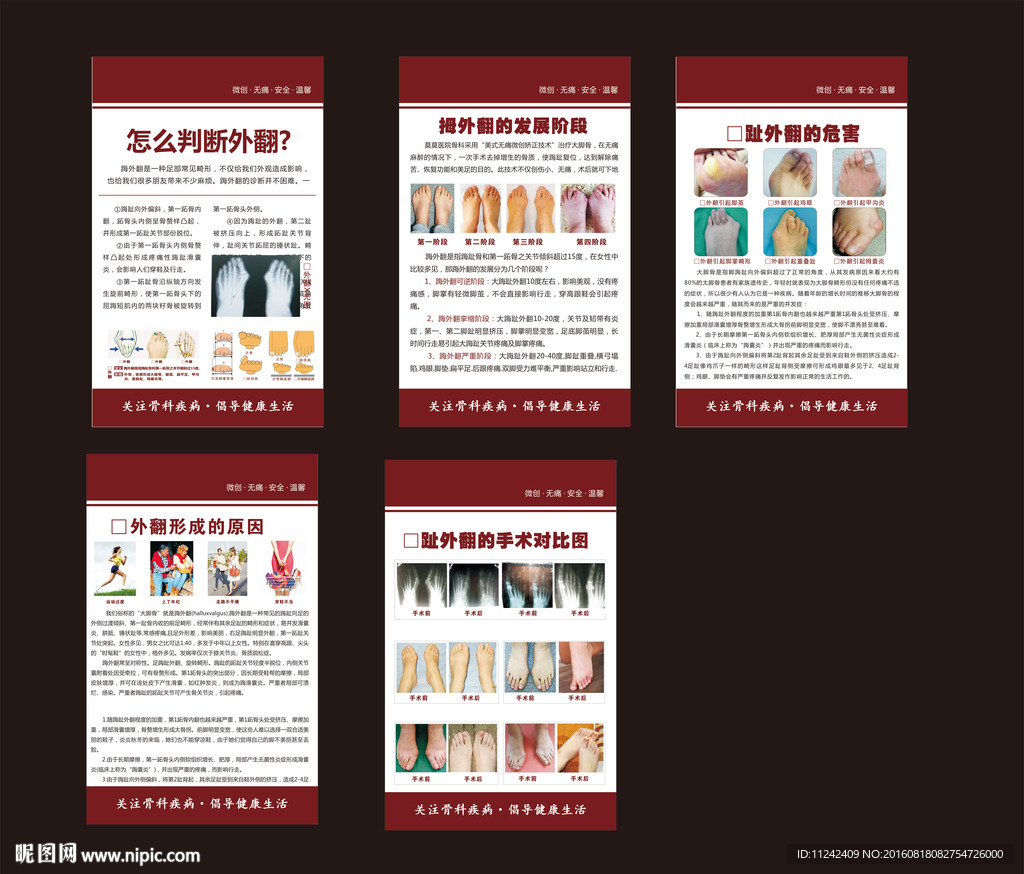 大脚骨/拇外翻挂图