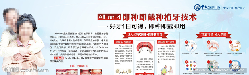 All-on-4即刻种植牙