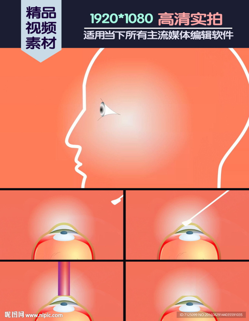 激光光学角膜切削术医学演示动画