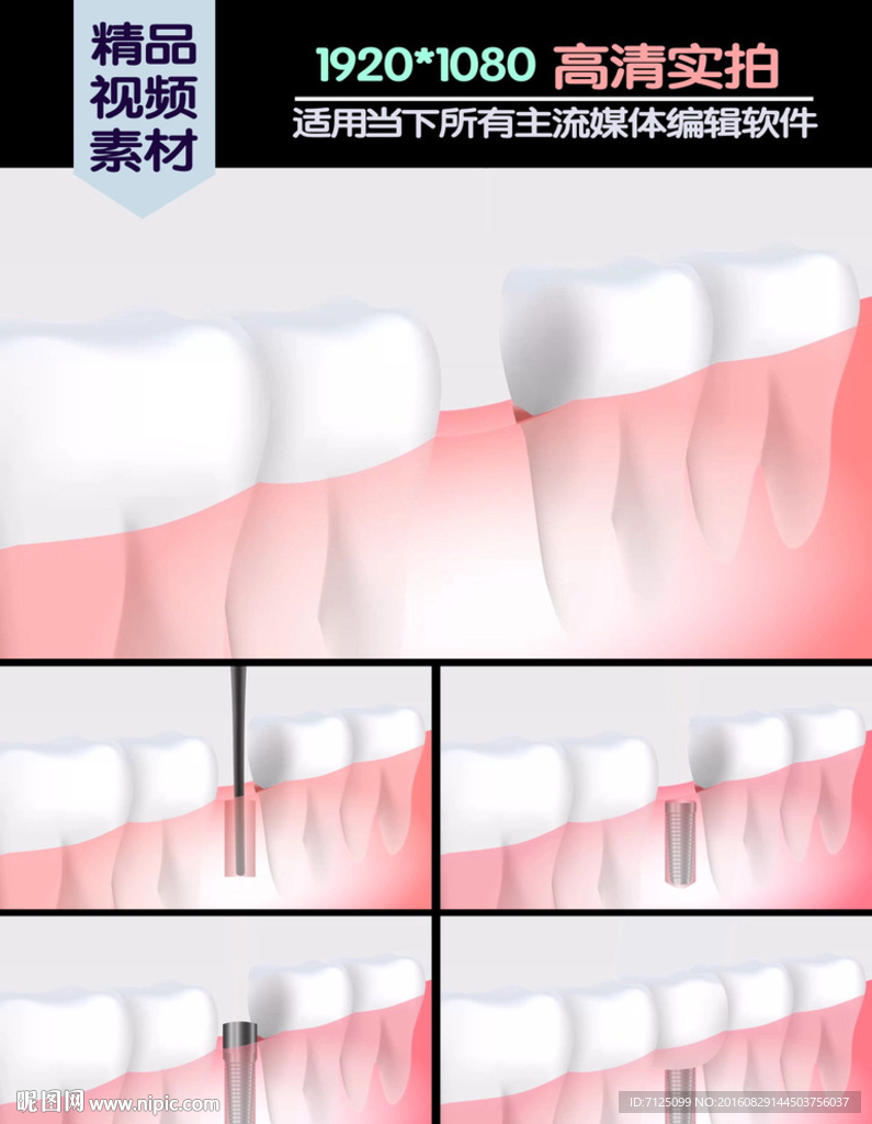 种植牙医学演示动画