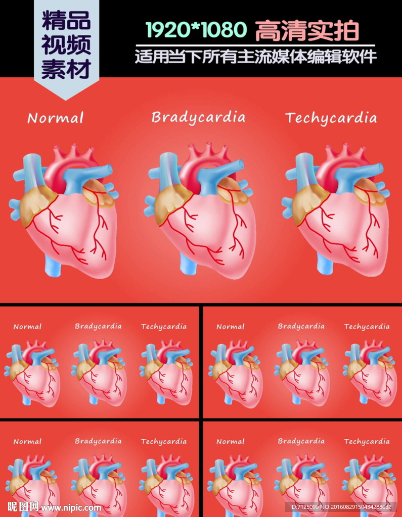 心脏病心律失常动画对比演示