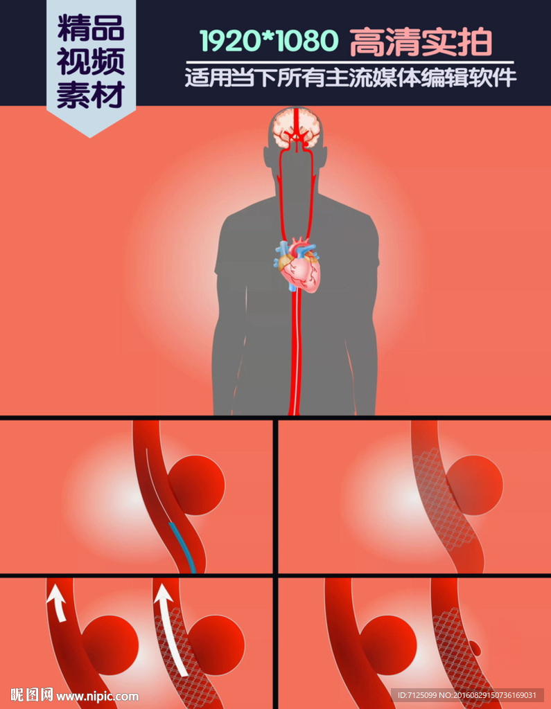 动脉瘤导流医学演示动画