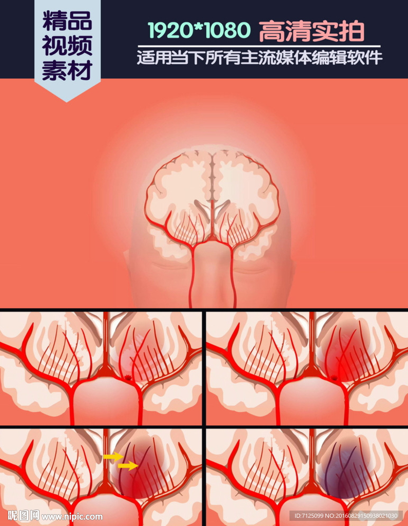 脑溢血医学演示动画