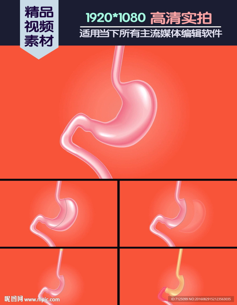 Vsg手术垂直袖状胃切除术