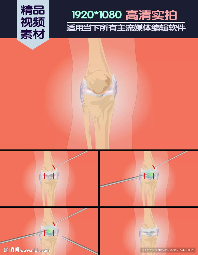 膝关节交叉韧带损伤修复医学演示