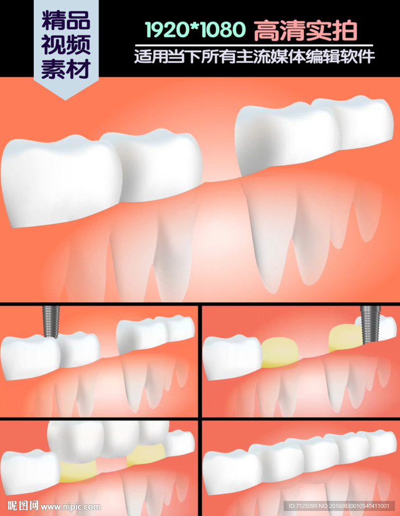 牙桥手术医学演示动画