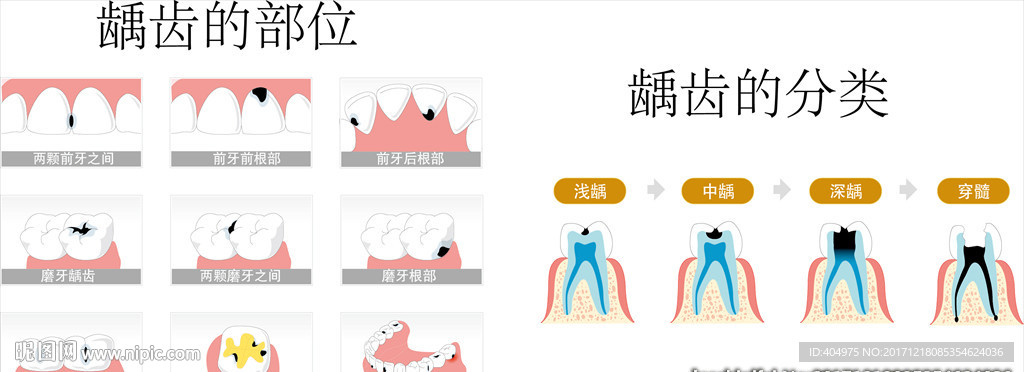 龋齿的部位与分类