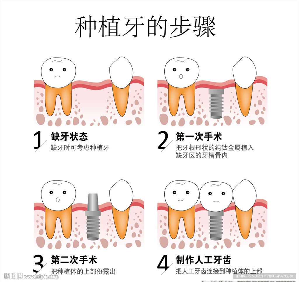 种植牙的步骤