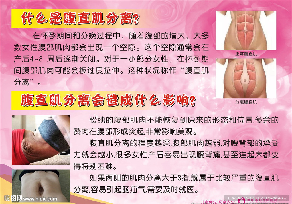 什么是腹直肌分离