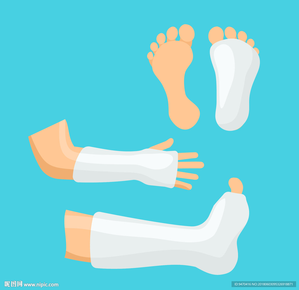 打石膏手脚医疗治理素材骨折保护