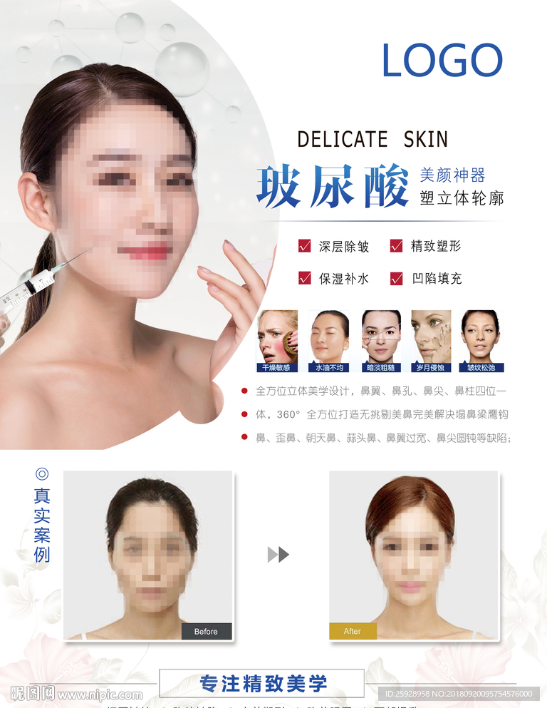 玻尿酸