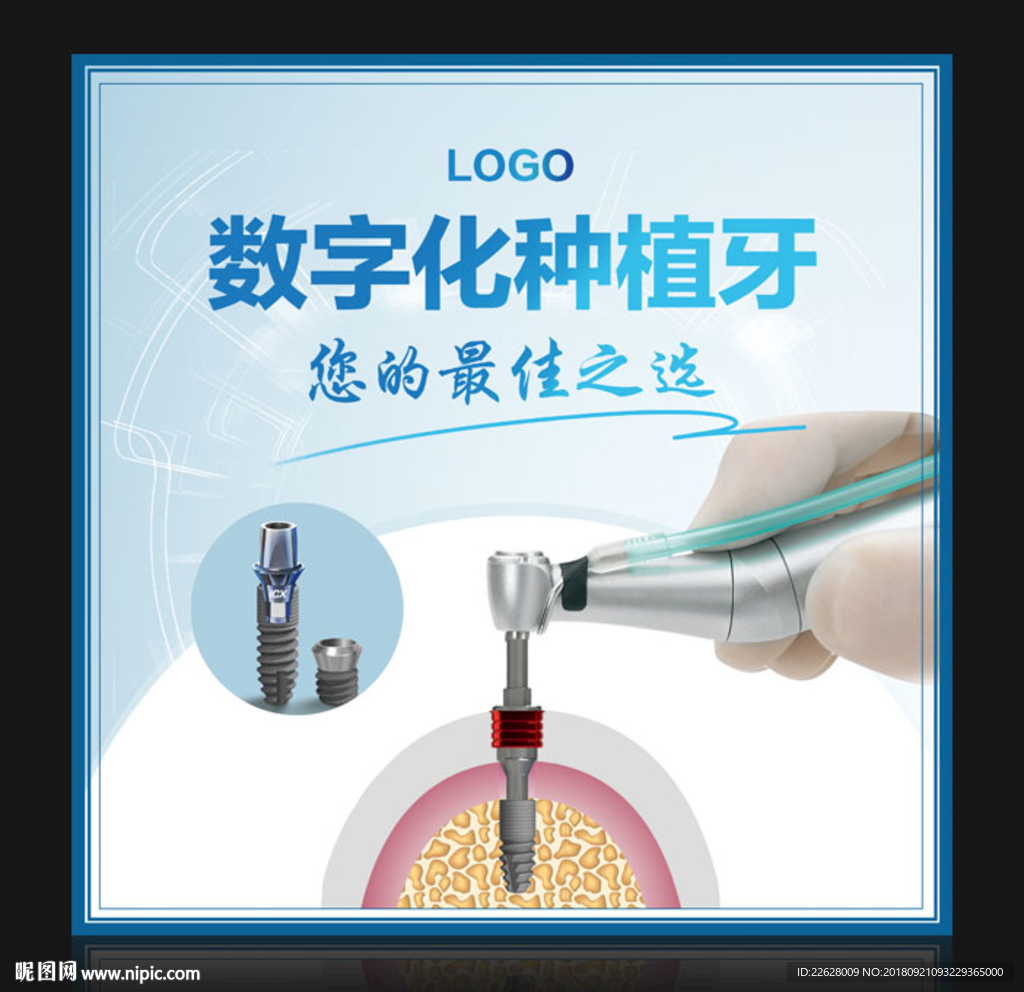 数字化种植牙