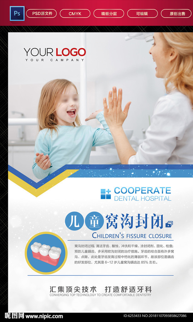 儿童窝沟治疗