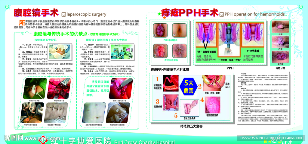 外科 腹腔镜手术 痔疮PPH
