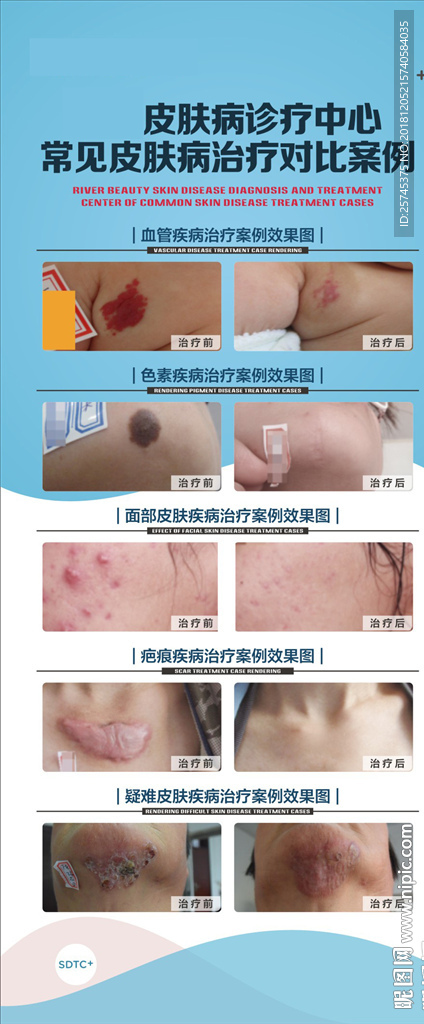 皮肤病 治疗 对比照片