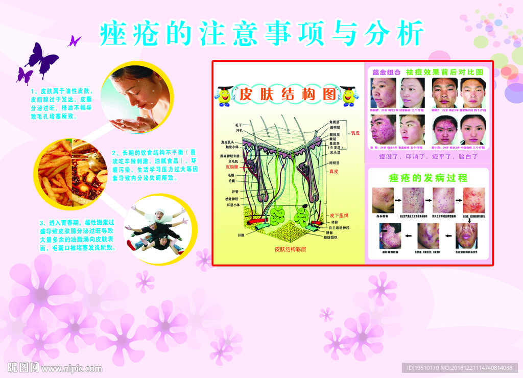 痤疮的注意事项