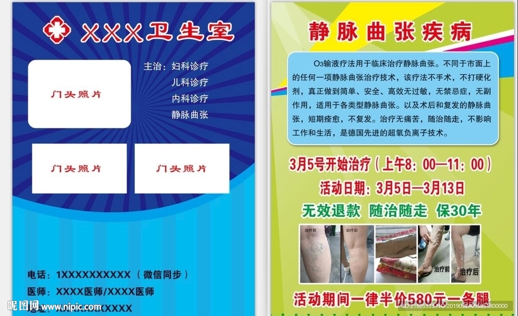 静脉曲张彩页