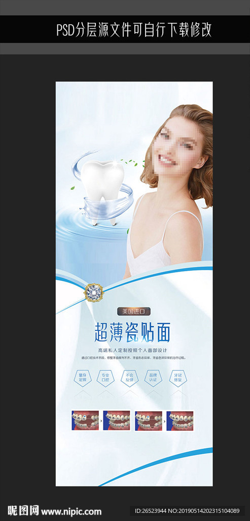 瓷贴面